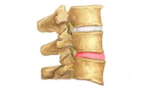脊柱椎间盘突出 - 骨软骨病的征兆
