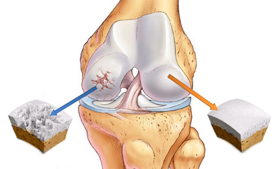 健康的膝关节（右）和受关节病影响的膝关节（左）