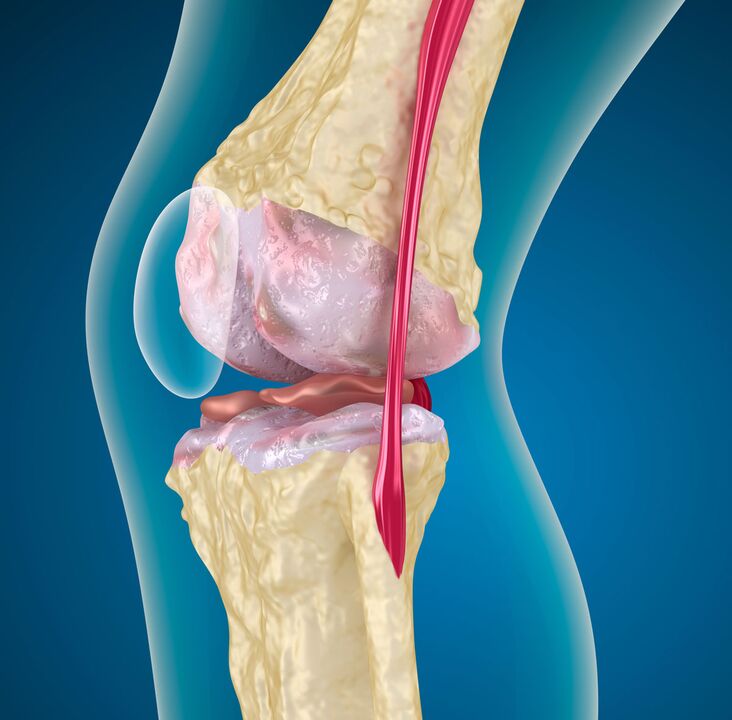 膝关节关节炎 - 一种退行性营养不良性疾病