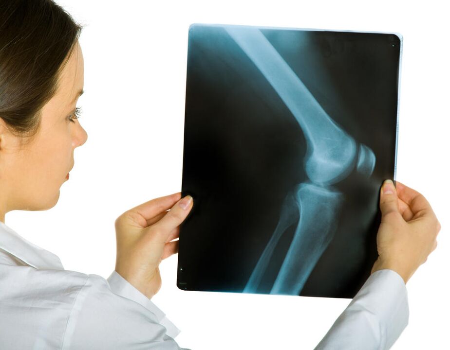 膝关节的 X 射线将显示关节变形的存在